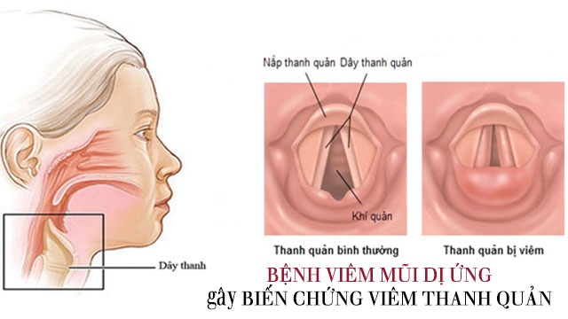 Biến chứng của bệnh viêm mũi dị ứng ở người già