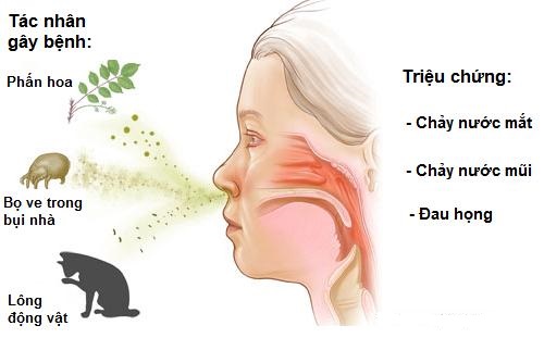 Nguyên nhân gây ra bệnh viêm mũi dị ứng